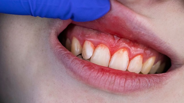 bai-viet/viem-nha-chu-nang-co-the-dan-den-bien-chung-nguy-hiem-gi.html