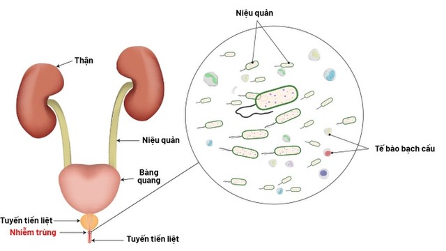 bai-viet/viem-nieu-dao-co-mu-nguyen-nhan-trieu-chung-va-cach-dieu-tri-hieu-qua.html