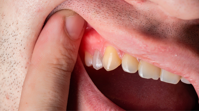 bai-viet/viem-nuou-la-gi-dau-hieu-nguyen-nhan-va-cach-phong-ngua.html