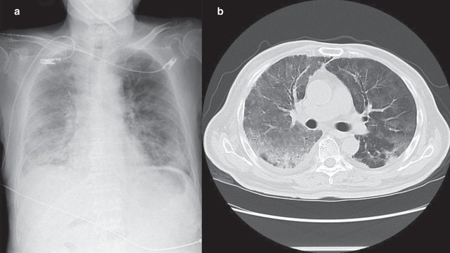 bai-viet/tim-hieu-tong-quan-ve-viem-phoi-ke-sau-covid-19.html