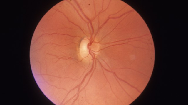 bai-viet/viem-thi-than-kinh-leber-nguyen-nhan-trieu-chung-chan-doan-va-dieu-tri.html