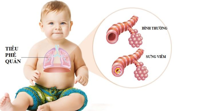 bai-viet/viem-tieu-phe-quan-o-tre-nguyen-nhan-trieu-chung-va-cach-phong-ngua-hieu-qua.html