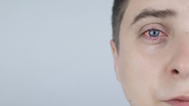 benh/viem-to-chuc-hoc-mat.html