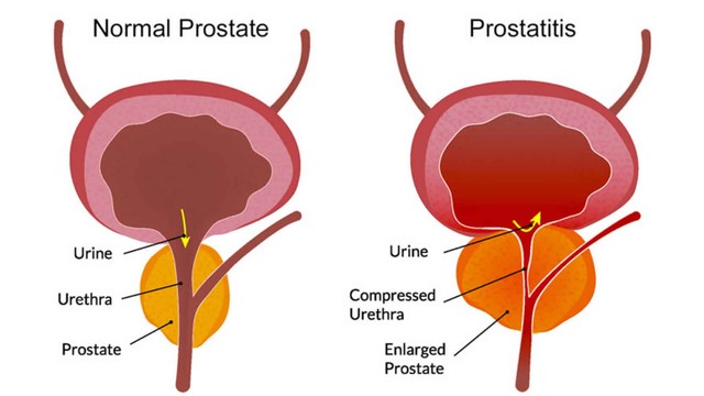 benh/viem-tuyen-tien-liet-cap-tinh.html