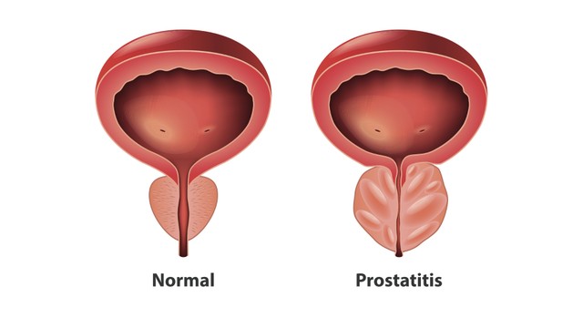 benh/viem-tuyen-tien-liet-man-tinh.html