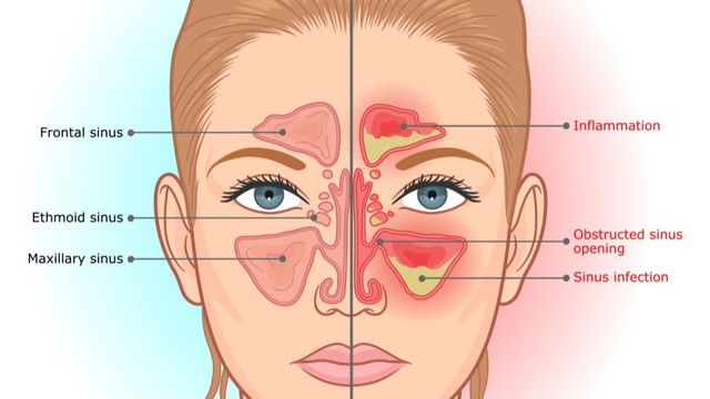 benh/viem-xoang-do-nam.html