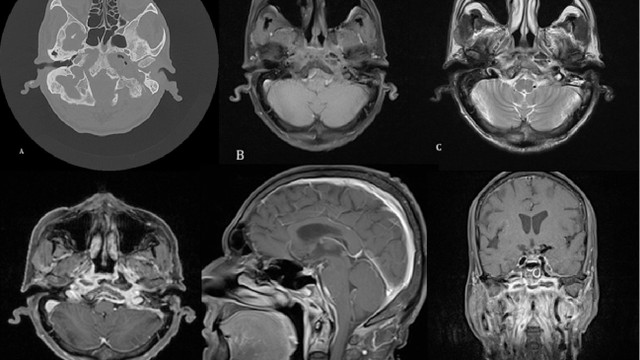 benh/viem-xuong-so.html