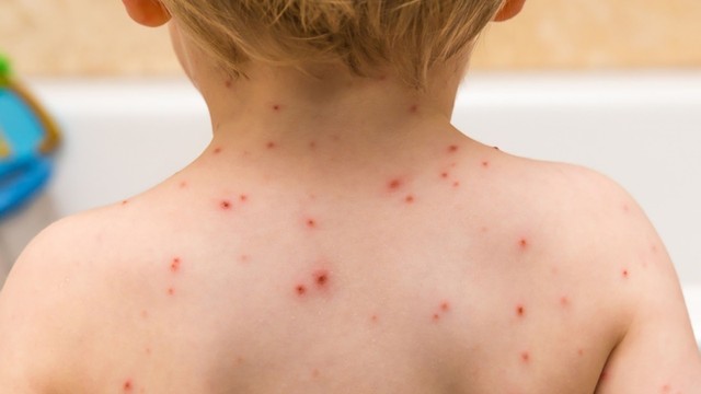 bai-viet/virus-thuy-dau-song-trong-bao-lau-cach-chua-tri-va-phong-ngua.html