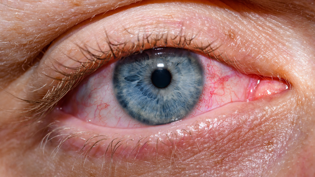 bai-viet/vo-mach-mau-mat-nguyen-nhan-nao-gay-ra-tinh-trang-nay.html