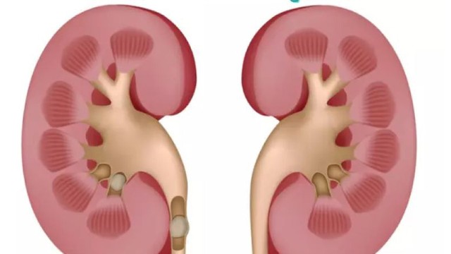 bai-viet/voi-hoa-than-nguyen-nhan-trieu-chung-va-cach-dieu-tri.html