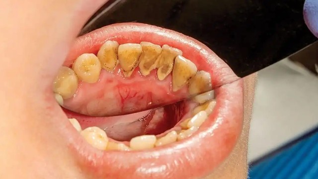 bai-viet/co-nen-de-voi-rang-tu-troc-khong-khi-nao-nen-lay-voi-rang.html