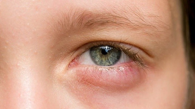 bai-viet/vung-da-quanh-mat-bi-sung-do-do-dau-va-cach-khac-phuc.html