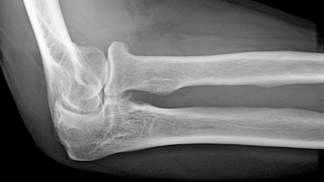 bai-viet/x-quang-khop-khuyu-la-gi-loi-ich-cua-x-quang-khop-khuyu.html