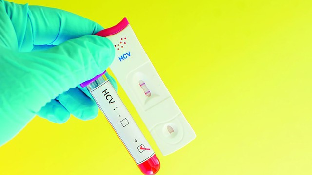 bai-viet/xet-nghiem-anti-hcv-tim-khang-the-chong-virus-viem-gan-c.html