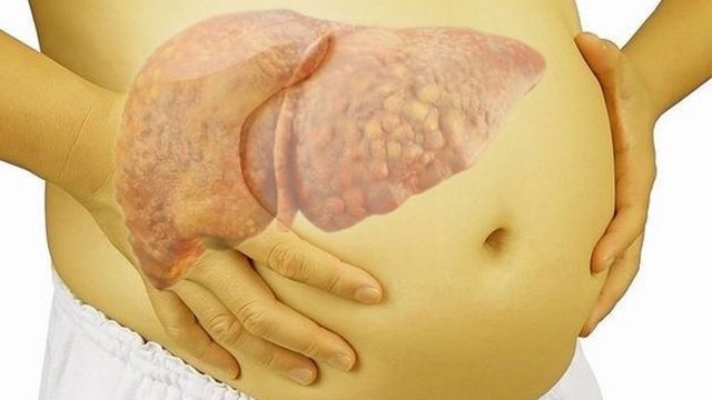 bai-viet/xo-gan-giai-doan-3-co-chua-duoc-khong-nguoi-benh-can-chu-y-nhung-gi.html