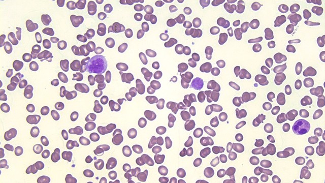 bai-viet/xo-tuy-xuong-nguyen-phat-la-gi-dau-hieu-nguyen-nhan-va-phuong-phap-dieu-tri.html