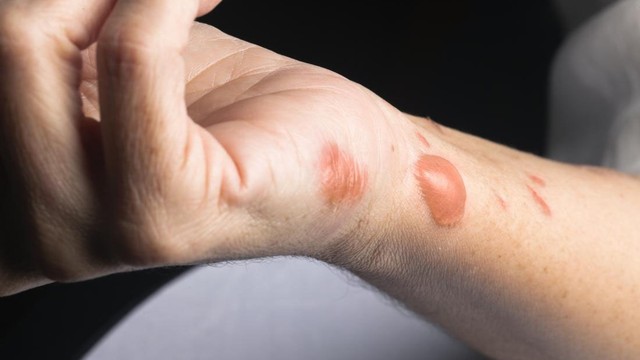 bai-viet/xu-ly-vet-bong-bi-phong-nuoc-dung-cach-de-tranh-nhiem-trung-71419.html