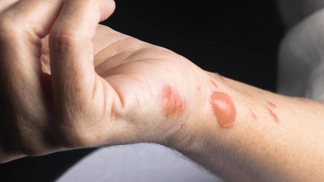 bai-viet/xu-ly-vet-bong-nhu-the-nao-de-khong-bi-seo-64586.html