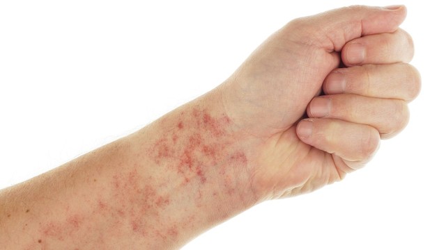 bai-viet/xuat-huyet-giam-tieu-cau-mien-dich-co-nhung-trieu-chung-gi.html