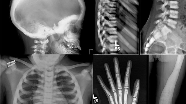 bai-viet/benh-xuong-hoa-da-va-nhung-rui-ro-tiem-an.html