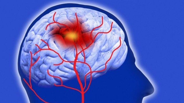 bai-viet/yeu-to-nguy-co-tai-bien-mach-mau-nao-va-cam-nang-danh-cho-benh-nhan.html