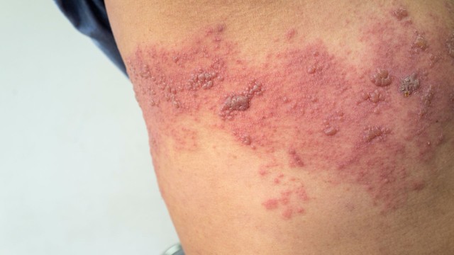 bai-viet/zona-o-nach-nguyen-nhan-trieu-chung-va-bien-phap-phong-ngua.html