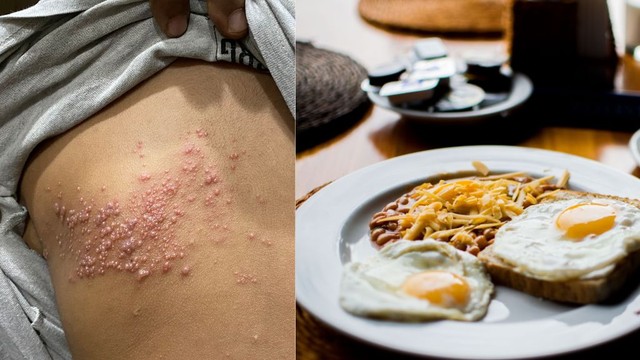 bai-viet/zona-than-kinh-co-duoc-an-trung-khong-nhung-luu-y-ve-che-do-dinh-duong.html