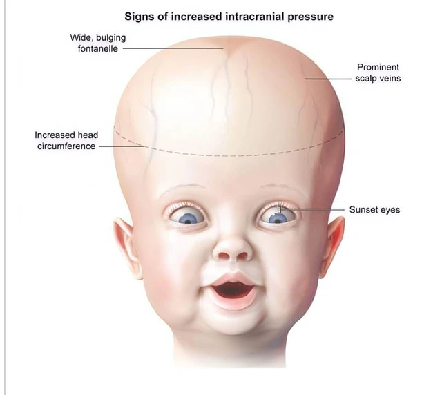 benh/hoi-chung-tang-ap-luc-noi-so-1005.html