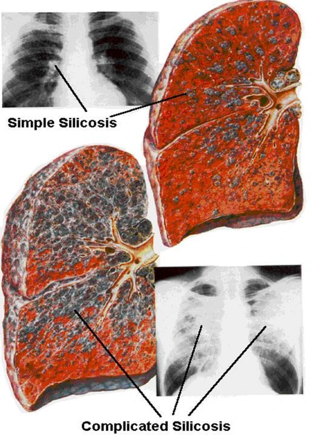benh/bui-phoi-silic-107.html