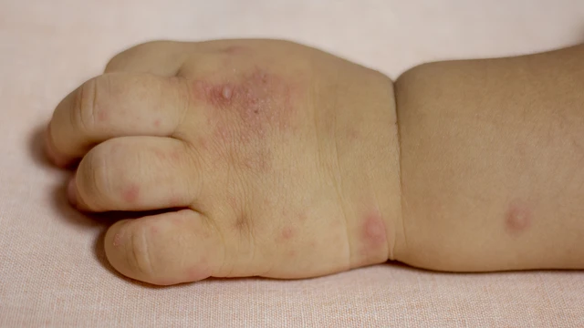 bai-viet/11-dau-hieu-tay-chan-mieng-nang-can-nhan-biet-som.html