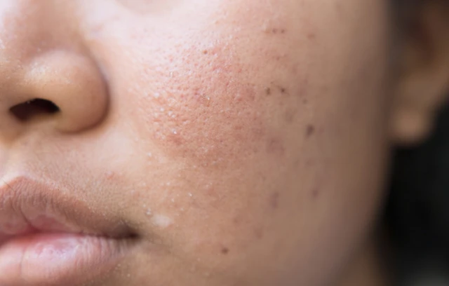 benh/mun-dau-den-1356.html