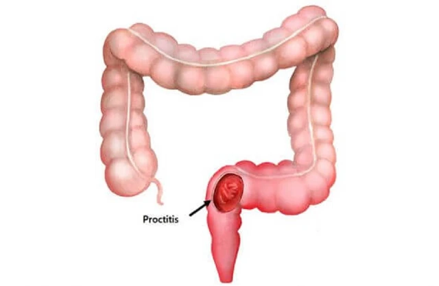 benh/viem-niem-mac-truc-trang-149.html