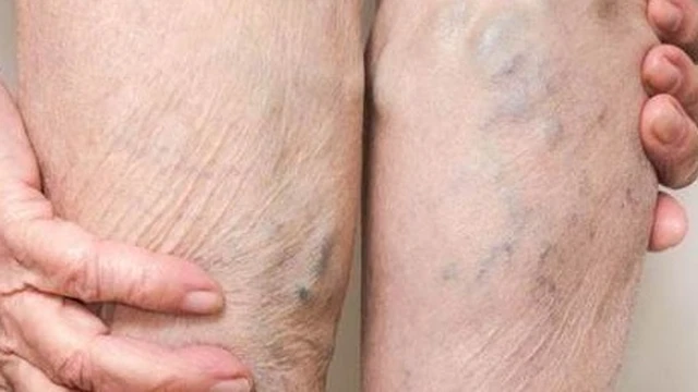 bai-viet/diem-qua-18-loi-khuyen-danh-cho-benh-nhan-suy-tinh-mach.html