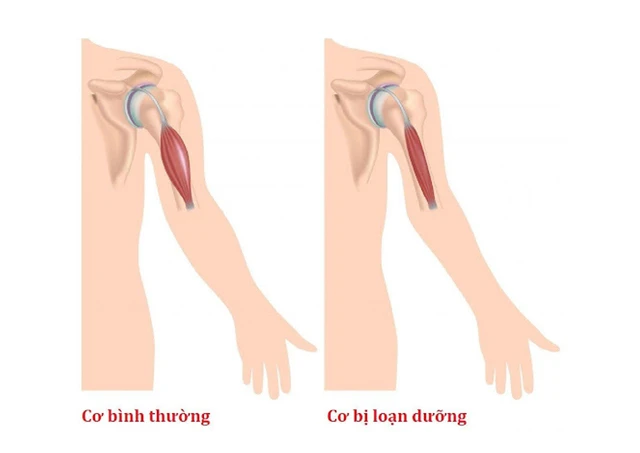 benh/loan-duong-co-19.html