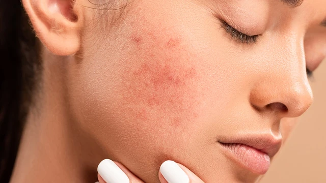 bai-viet/nen-hay-khong-nen-boc-vay-mun-lam-the-nao-de-cham-soc-vung-da-mun-hieu-qua.html