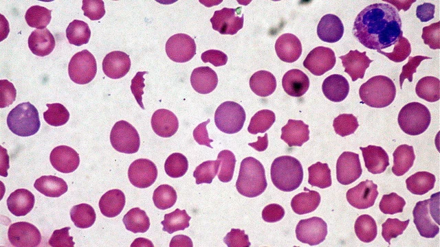 bai-viet/nhung-bien-phap-nao-giup-phong-ngua-tang-bach-cau-ai-toan.html