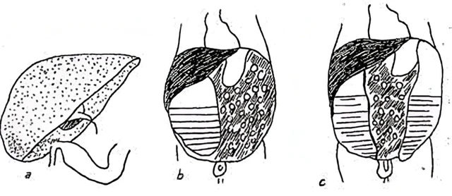 benh/tac-ruot-so-sinh-245.html