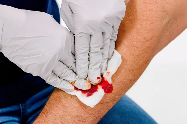 benh/benh-ua-chay-mau-262.html