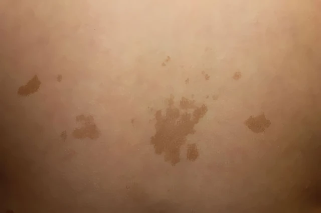 benh/u-soi-than-kinh-286.html