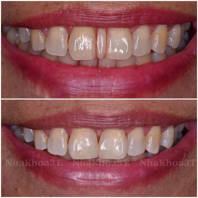 benh/rang-thua-340.html