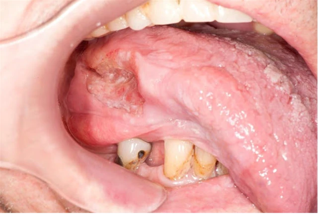 benh/ung-thu-mieng-387.html