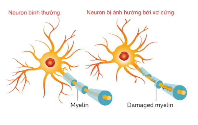 benh/xo-cung-rai-rac-38.html