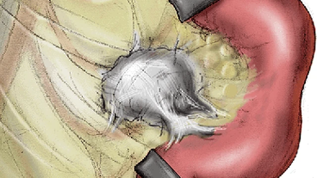 bai-viet/u-mac-treo-la-gi-co-nguy-hiem-khong.html