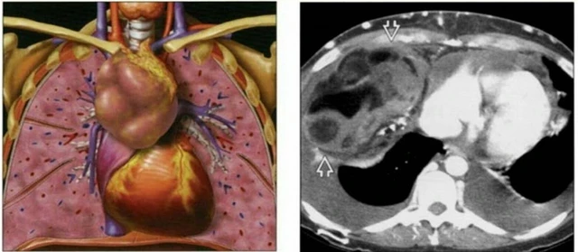 benh/u-trung-that-422.html