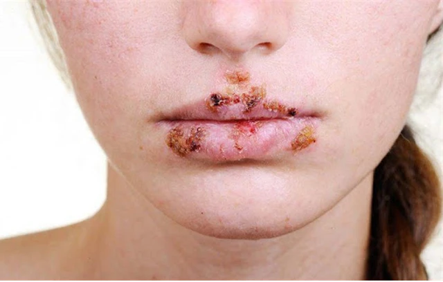 benh/ha-cam-mem-439.html