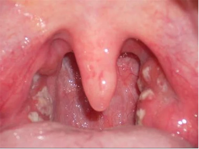 benh/nam-hong-460.html