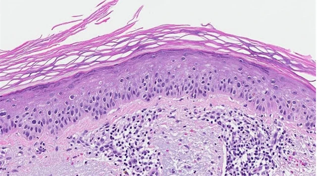 benh/day-sung-anh-sang-520.html