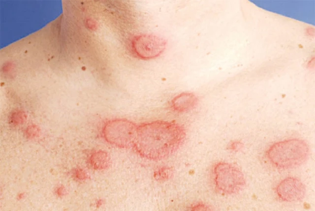 benh/lupus-ban-do-526.html