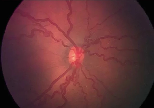 benh/benh-vong-mac-tre-sinh-non-540.html