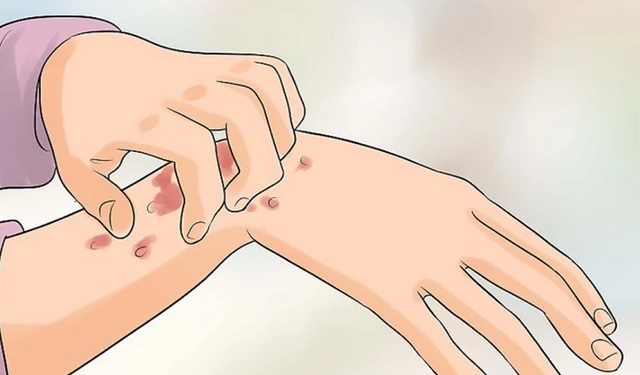 benh/ghe-coc-do-nhiem-treponema-pertenue-584.html